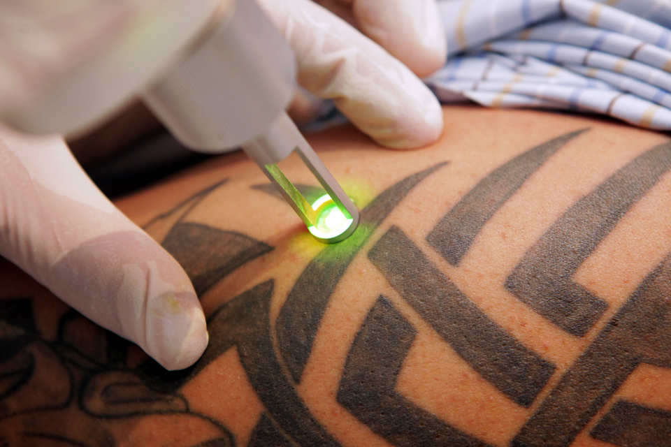 Detatouage Tatouage Laser