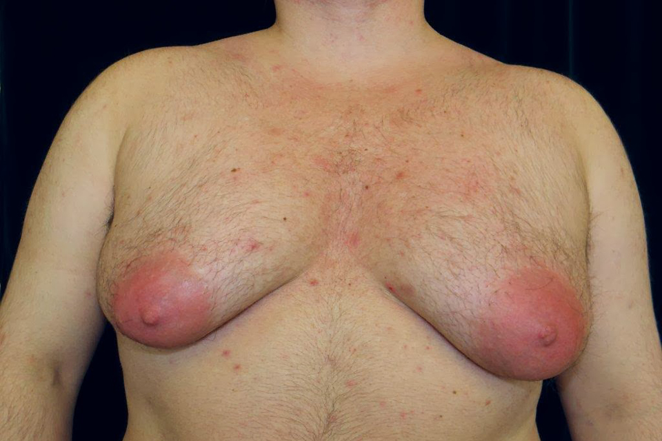 Gynecomastie