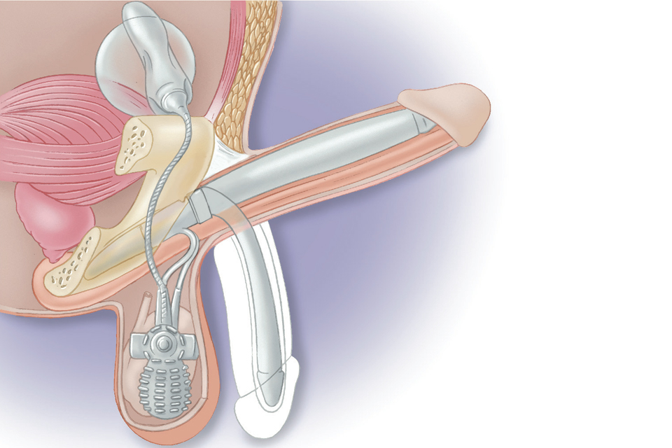 Implants Peniens