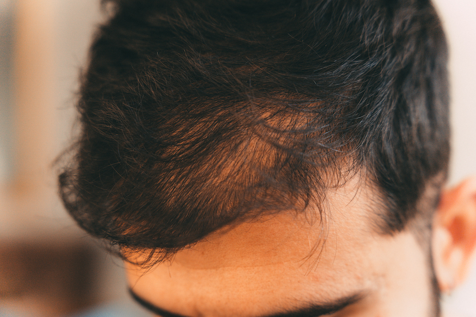 Comment choisir ma clinique pour une greffe de cheveux ?