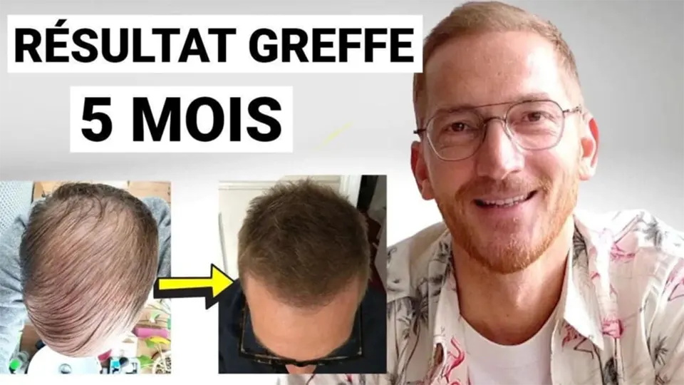 temoignage greffe cheveux monsieur cheveux
